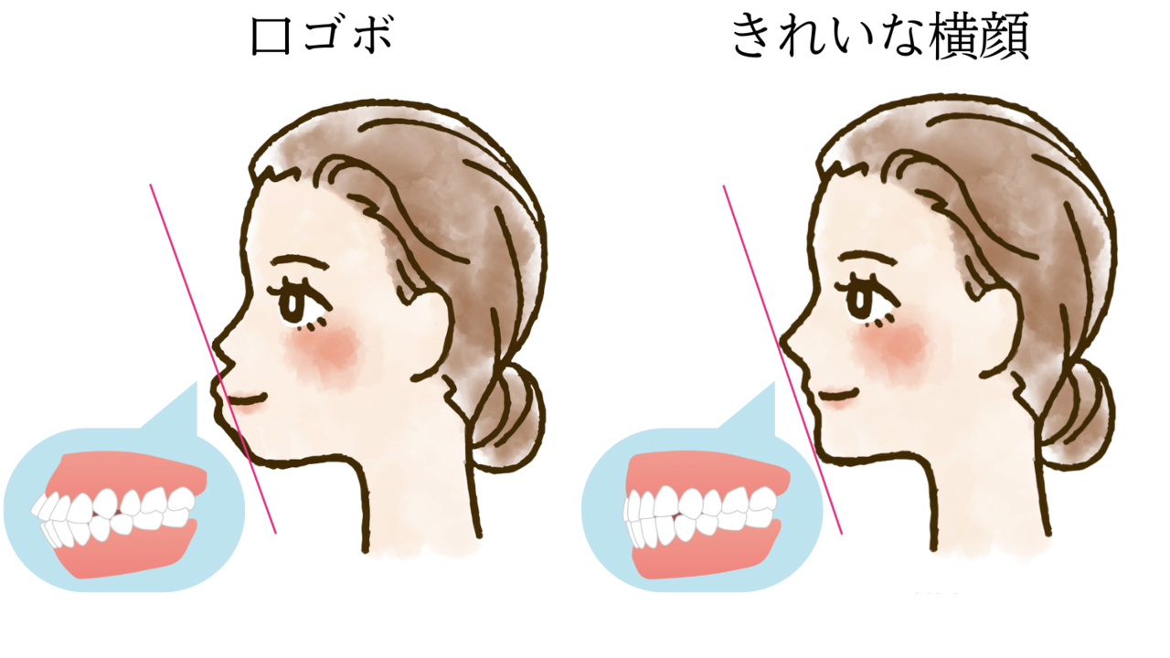 矯正治療で口ゴボになった